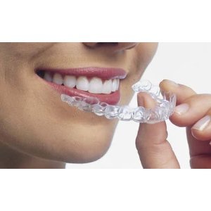 Smile Whitening Kits