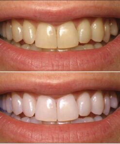before and after Carbamide Peroxide Refill