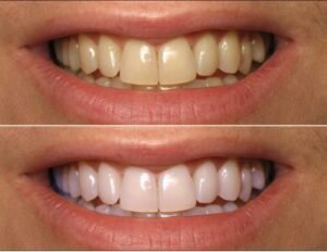 Whitening Gel 
